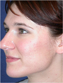 Blue Light Acne Treatment After