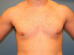 male breast reduction - after