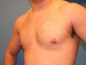 male breast