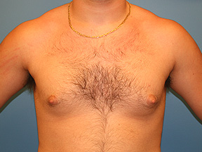 male breast reduction - before