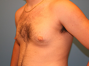 male breast