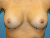 Breast Augmentation After