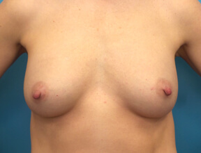 Breast Implant After