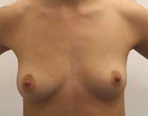 Breast Augmention Before