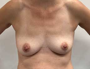 Breast Augmention Before