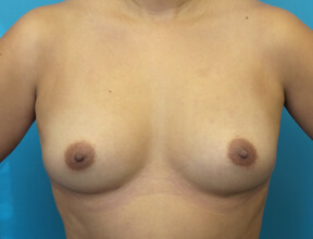Fat Graft Breast After