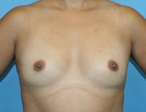 Fat Graft Breasts Before