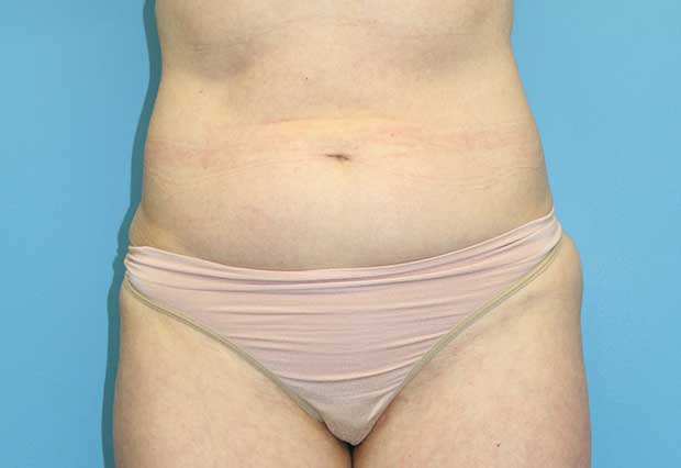 10 Pound Weight Loss Before And After Men`s Liposuction And Cosmetic Surgery