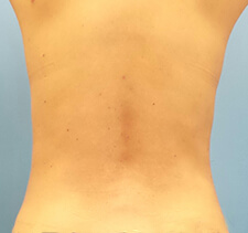 lipo Back