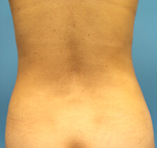 liposuction before