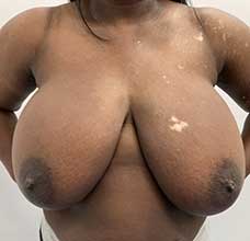Breast Reduction - Before