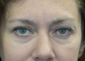 Botox Droopy Eyelid After