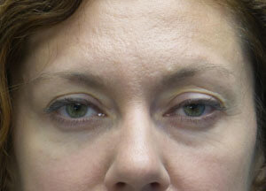 Botox Droopy Eyelid Before