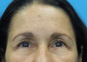 Botox After