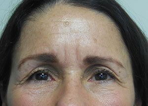 Botox Before