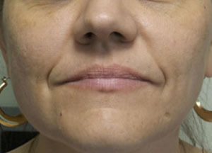 Botox After