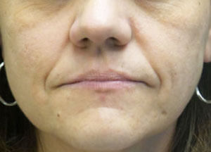 Botox Before