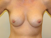 Implant After