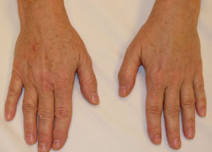 radiesse hands after