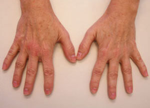 radiesse hands before