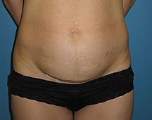 abdominoplasty