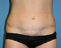 abdominoplasty