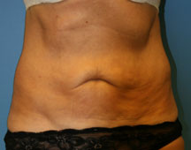 Abdominoplasty