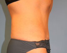 Abdominoplasty Side After