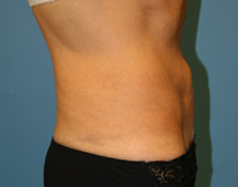 Abdominoplasty