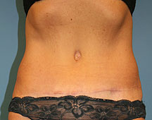 Abdominoplasty After