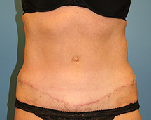 tummy tuck after