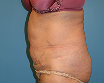 tummy tuck before