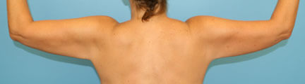 Arm Lipsuction After
