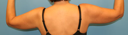 Arm Liposuction Before