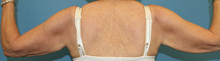 Arm Lift Before