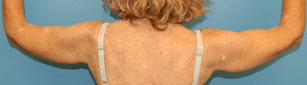 Arm Liposuction After