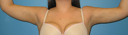 Arm lipo after