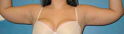 Arm lipo before