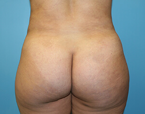 buttlift after