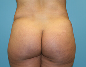 buttlift before