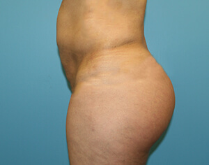 buttlift before