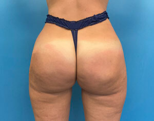 buttlift after