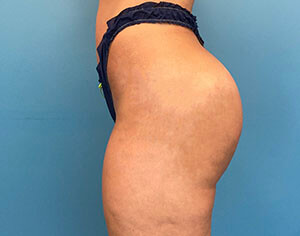 buttlift after