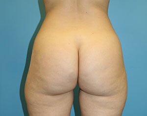 buttlift before