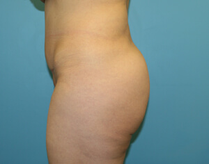 buttlift before