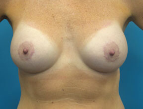 Breast Lift After