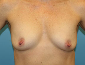 Breast Lift Before