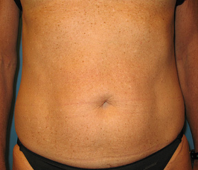 abdominal thermage