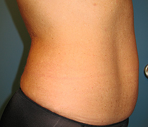 thermage after
