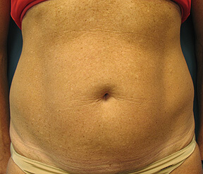 body by thermage